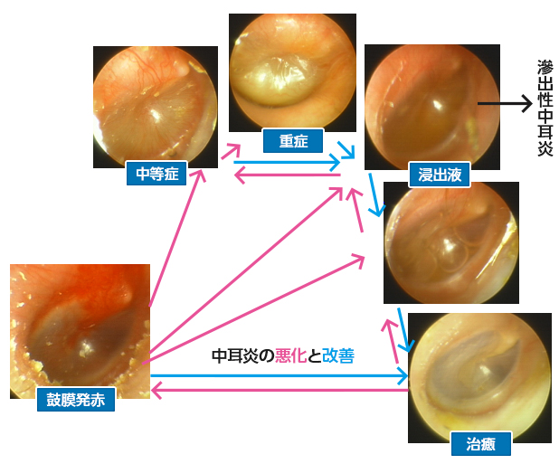 鼓膜 の 動き が 悪い 原因